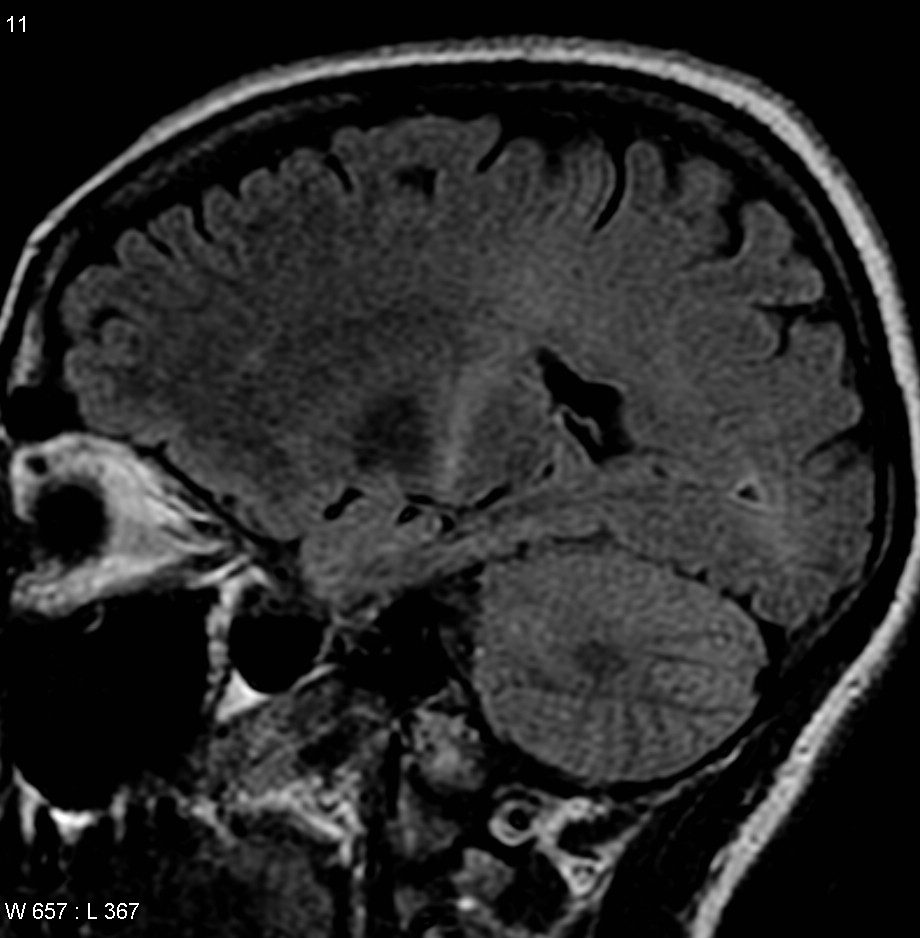 Coronal MRI consistent with ALS