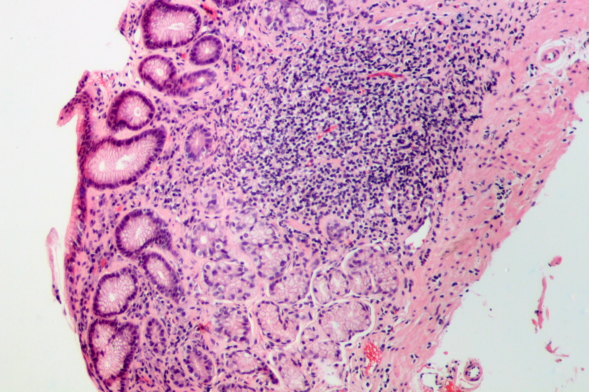 Gastritis por H. pylori en tinción H&E — lámina 1