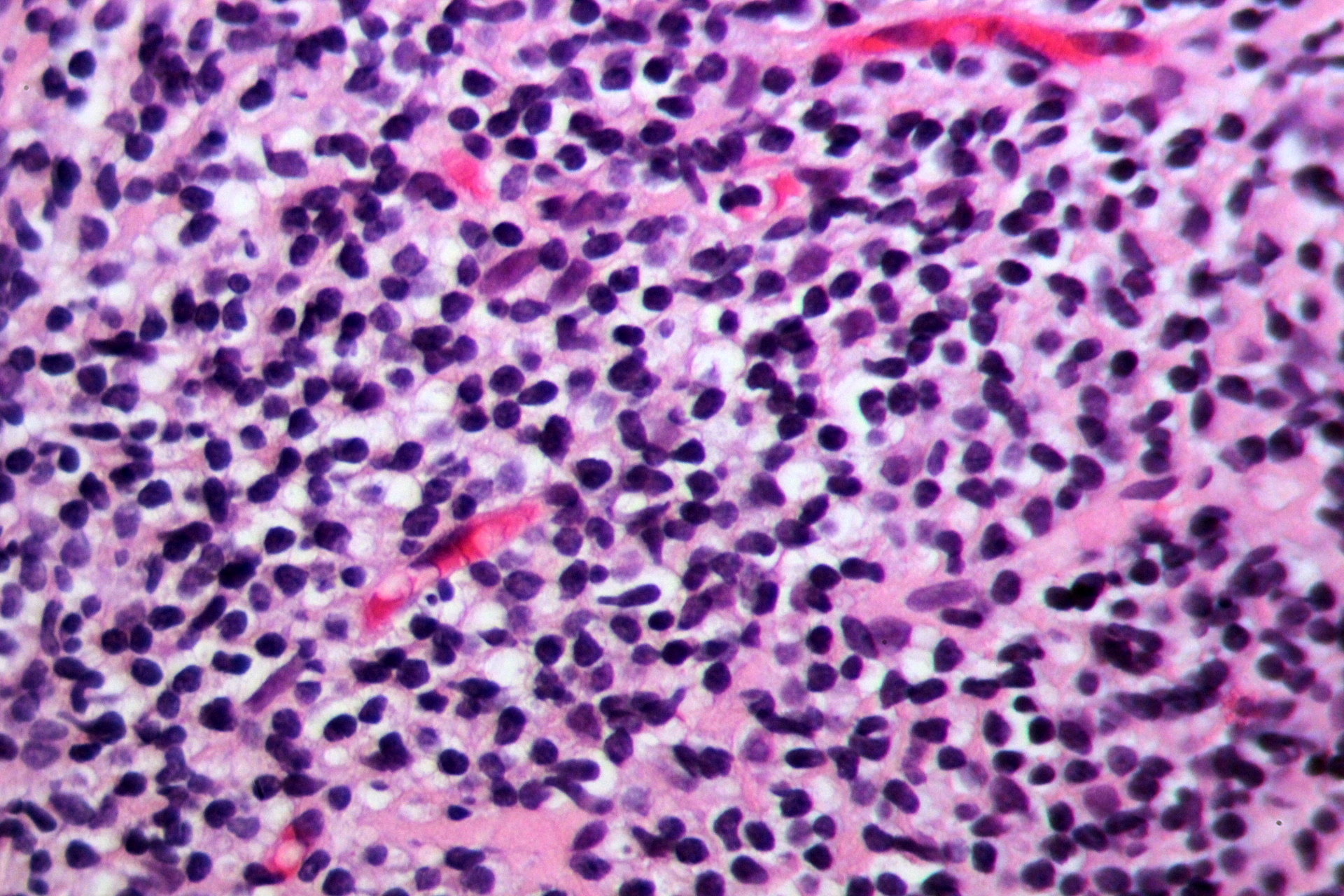 Gastritis por H. pylori en tinción H&E — lámina 2