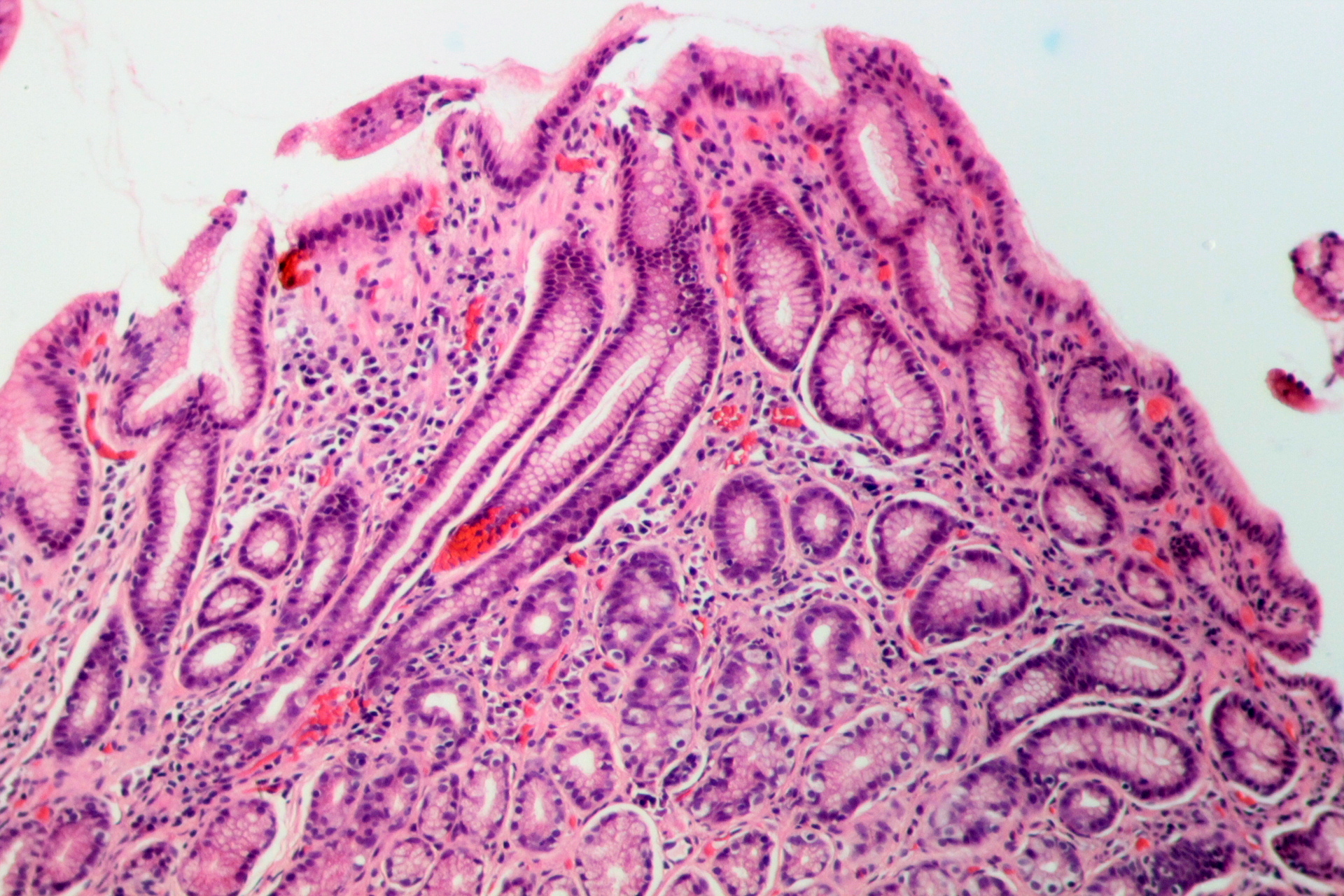 Gastritis por H. pylori en tinción H&E — lámina 3