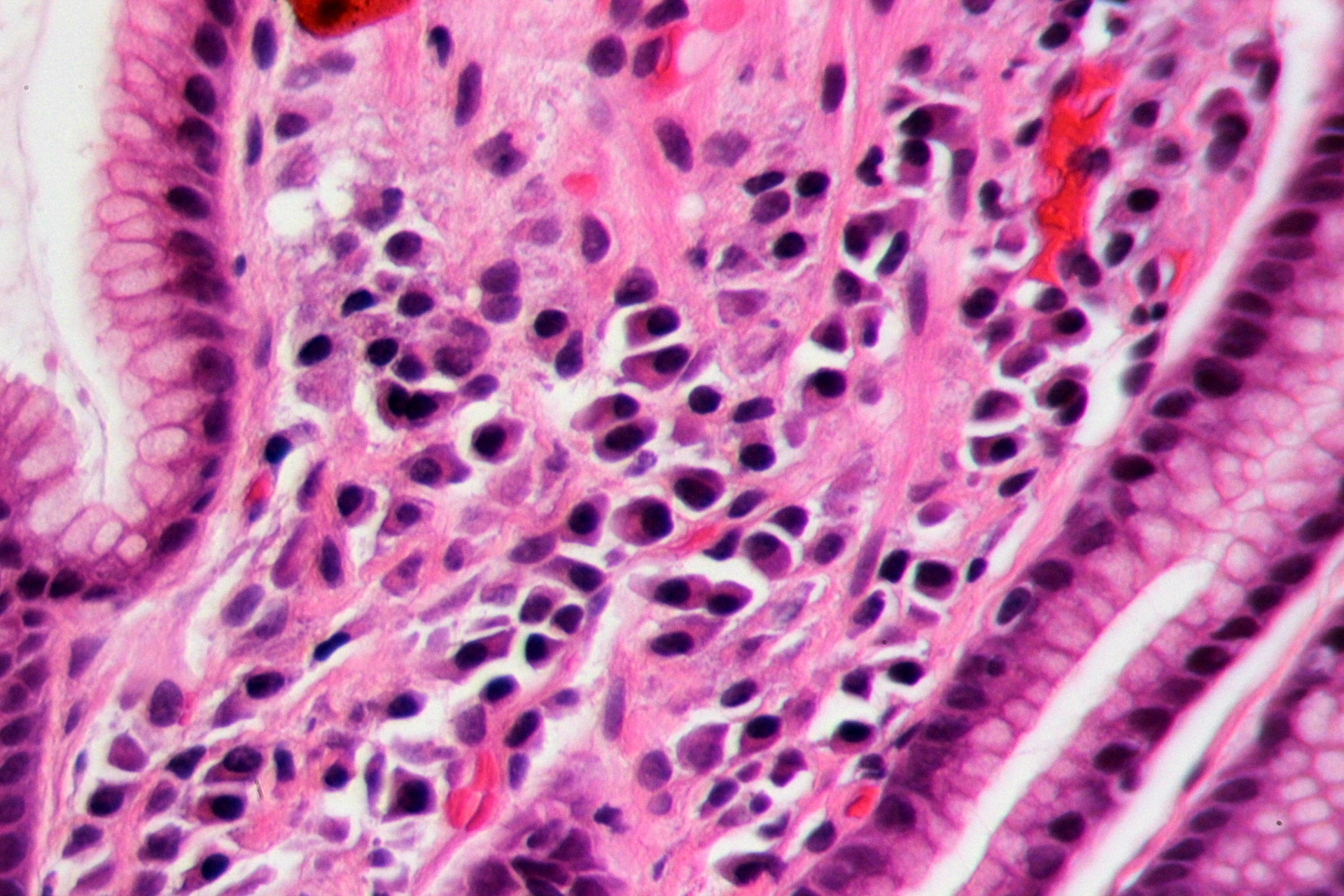 Gastritis por H. pylori en tinción H&E — lámina 4