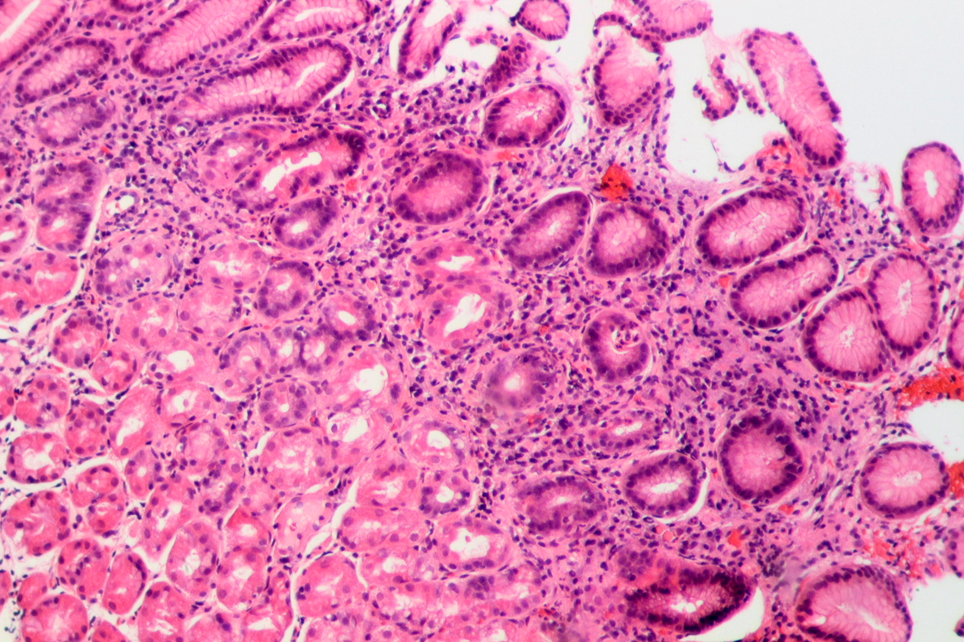 Gastritis por H. pylori en tinción H&E — lámina 5