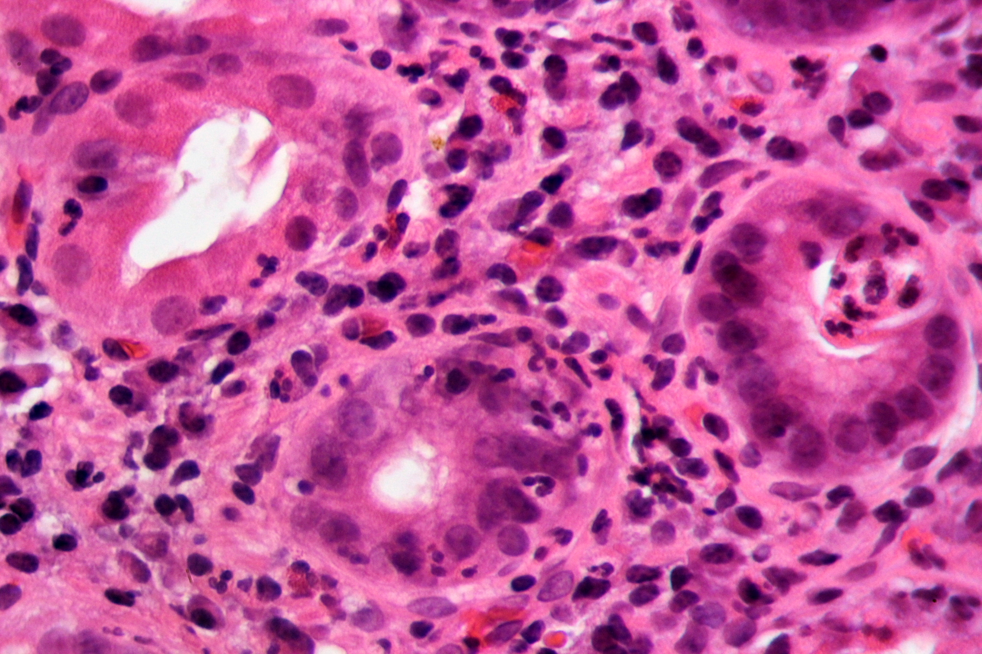 Gastritis por H. pylori en tinción H&E — lámina 6