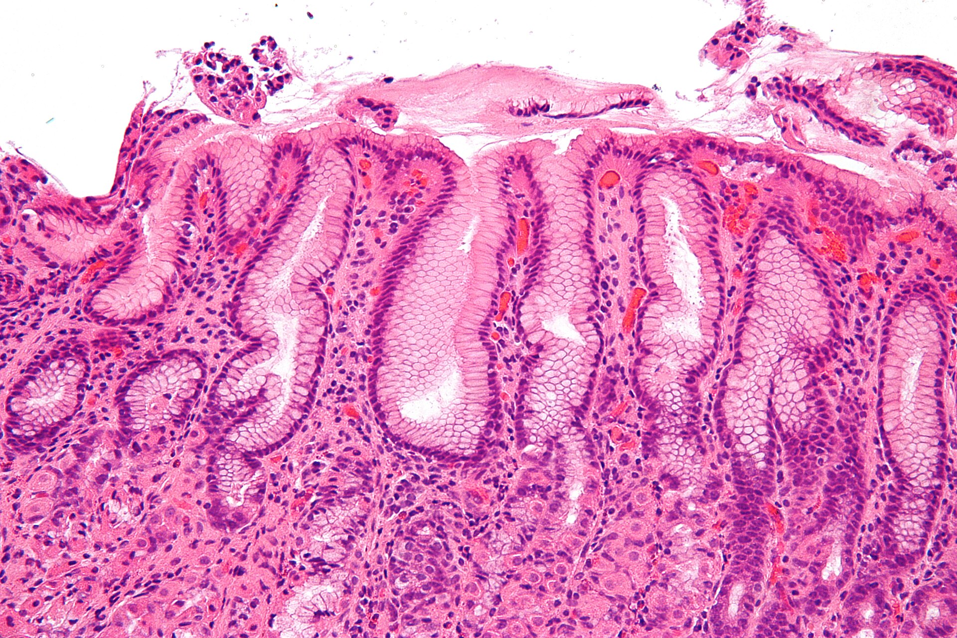 Gastritis por Helicobacter a gran aumento