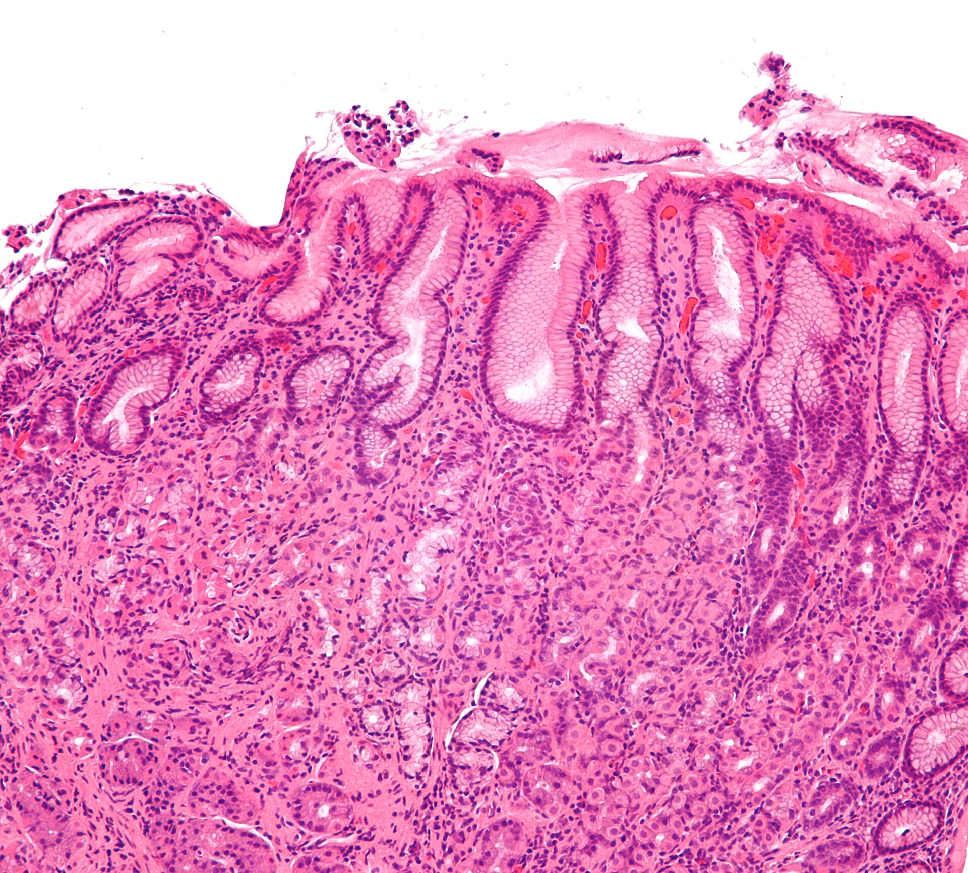 Gastritis por Helicobacter a aumento medio
