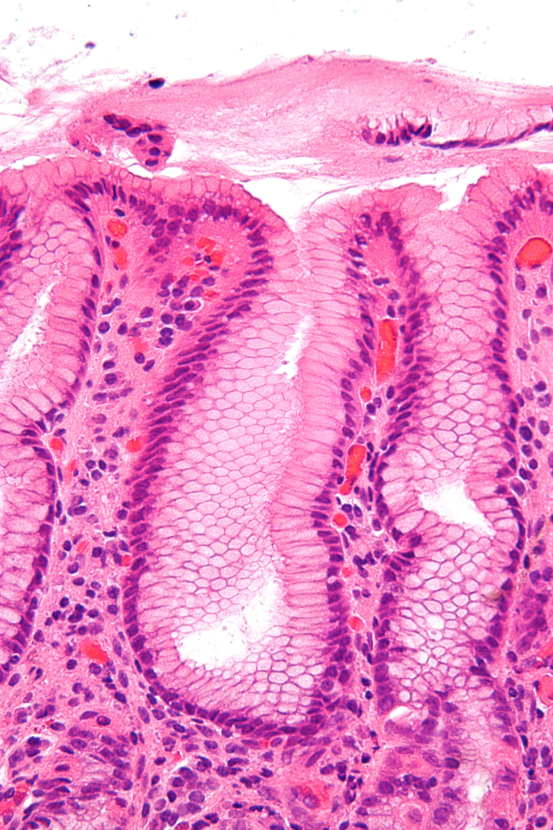 Gastritis por Helicobacter a muy alto aumento