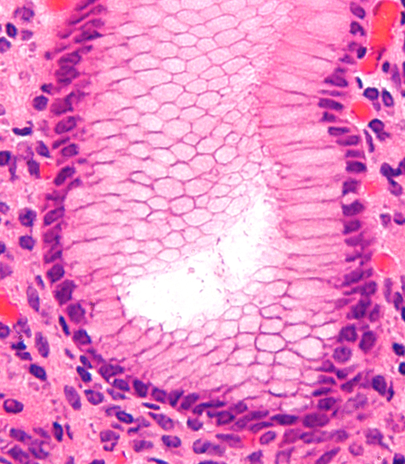 Gastritis por Helicobacter a muy alto aumento, detalle