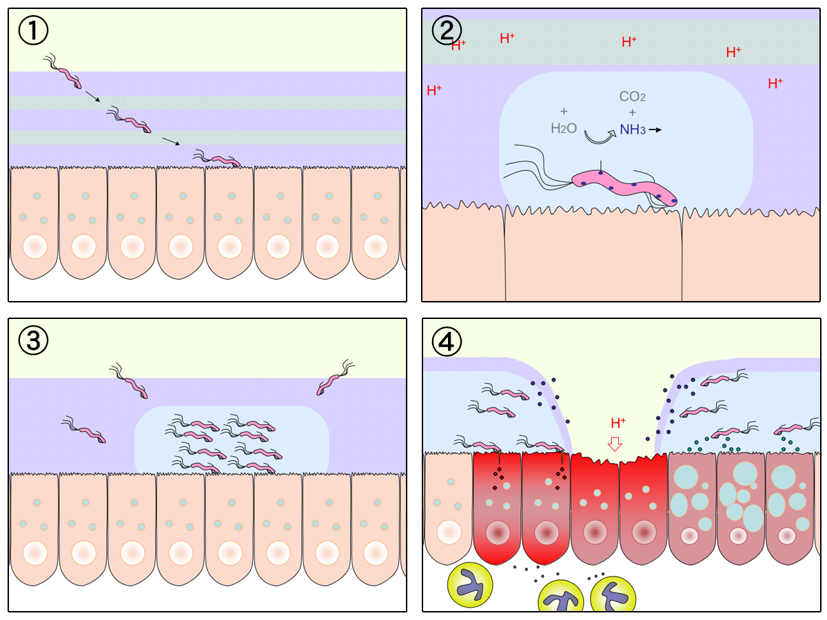 Esquema de H. pylori y úlcera gástrica