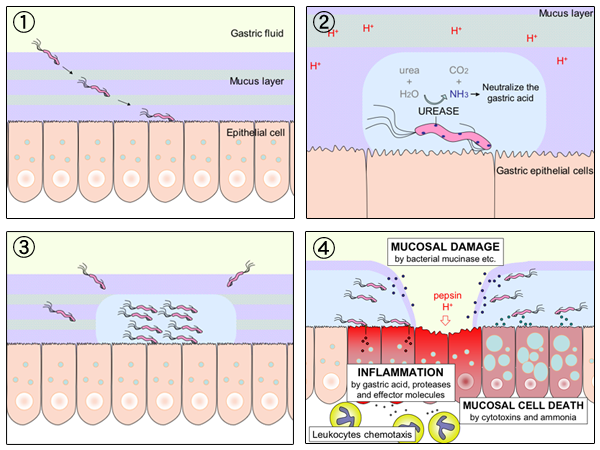 Esquema de H. pylori y úlcera gástrica