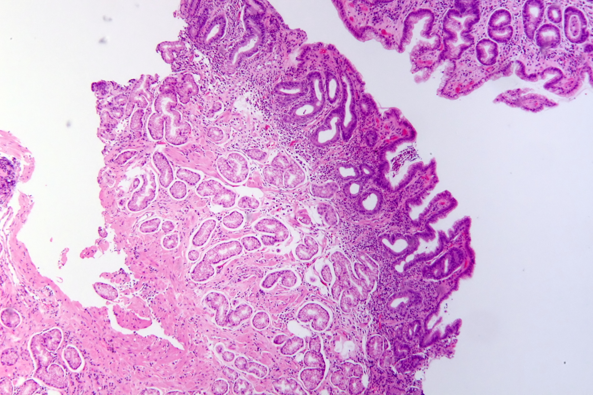 Gastritis por Helicobacter pylori