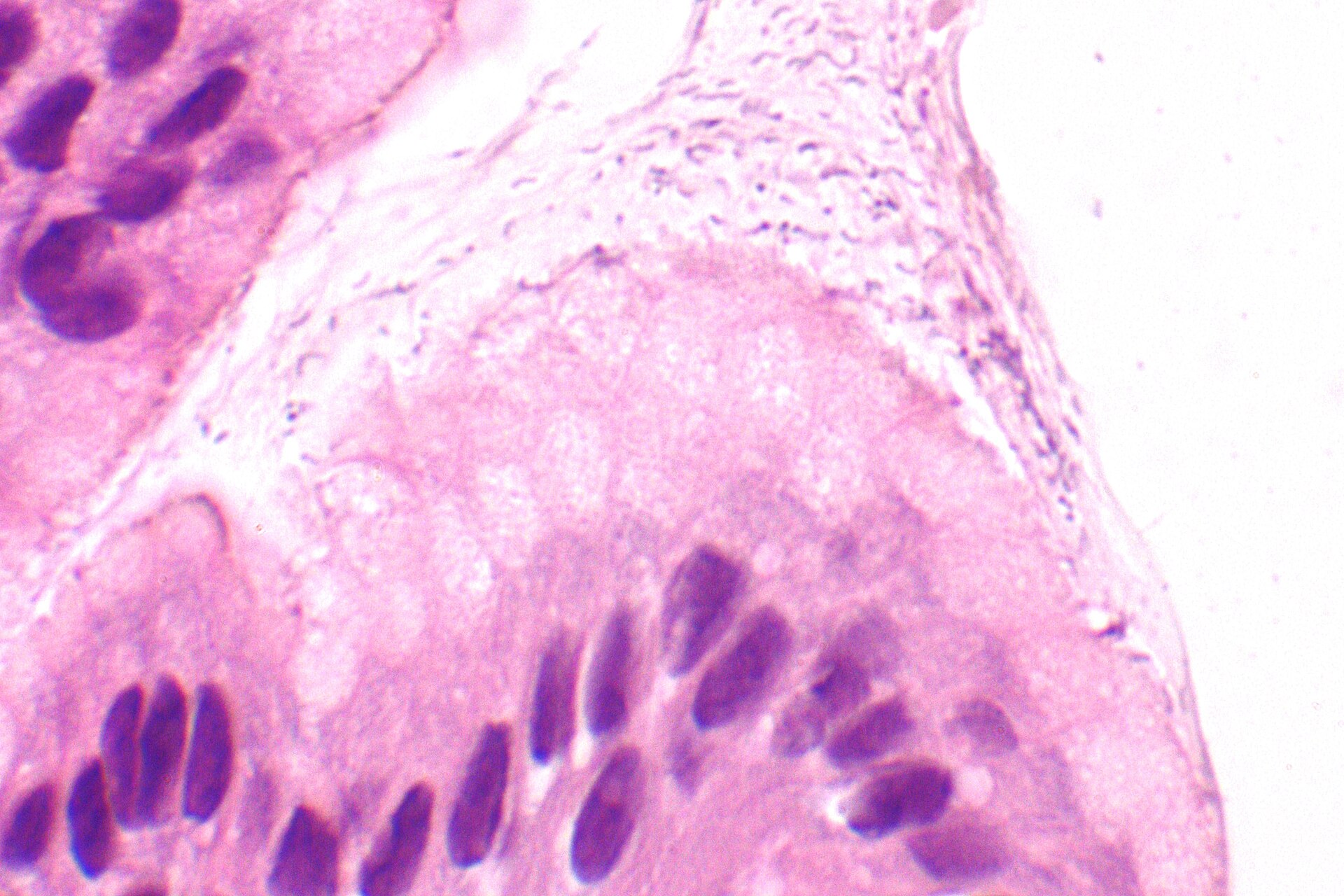 Detalle microscópico de gastritis por Helicobacter