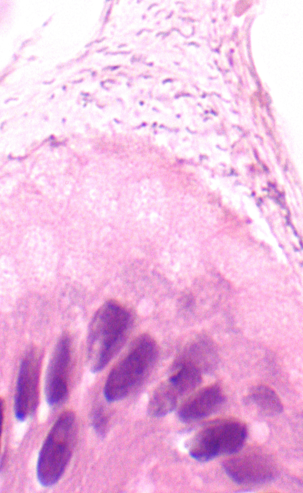 Campo ampliado de gastritis por Helicobacter