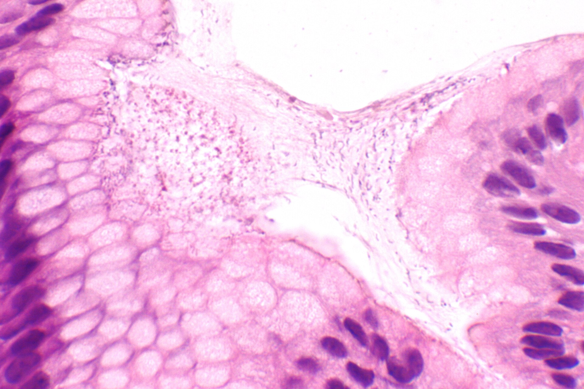 Helicobacter gastritis a muy alto aumento