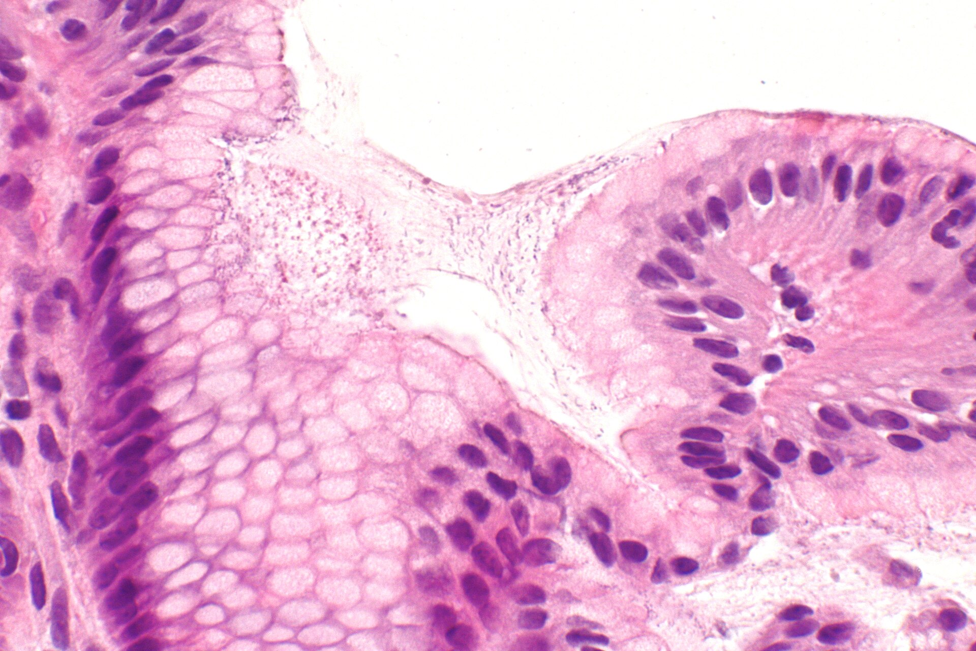 Helicobacter gastritis a gran aumento