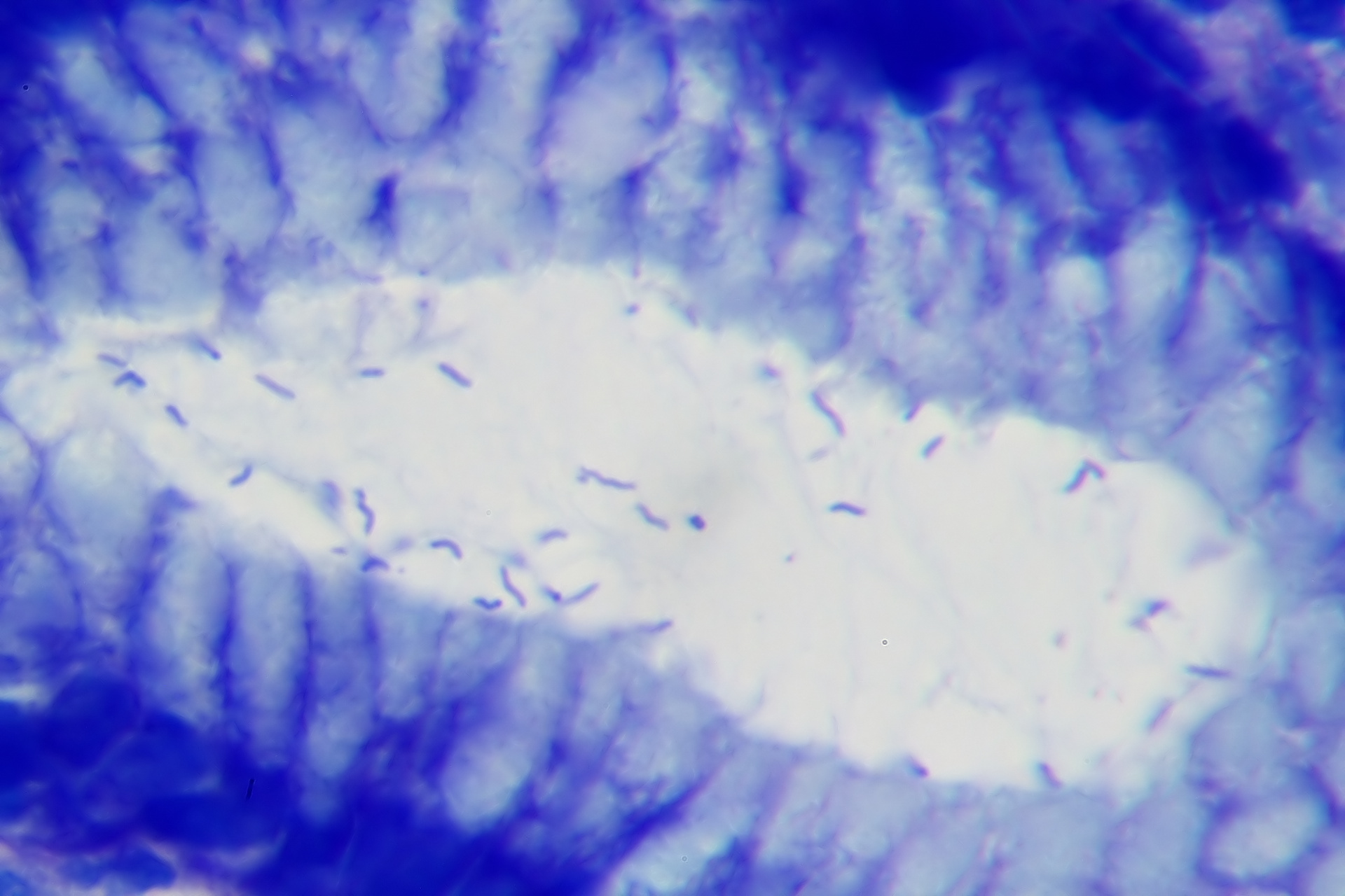 H. pylori en un caso de gastritis