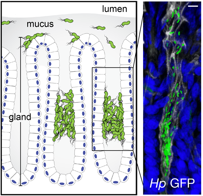 Micronichos de H. pylori en gastritis