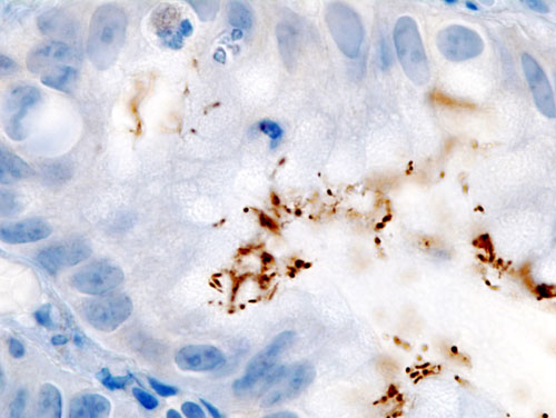 Detección inmunohistoquímica de H. pylori