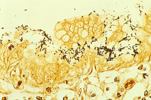 Gastritis asociada a Helicobacter pylori